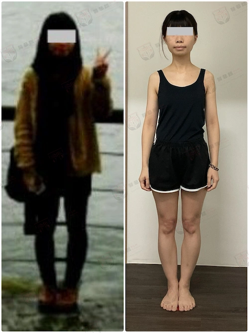 CASE 05 - 腿型不直 Before/After