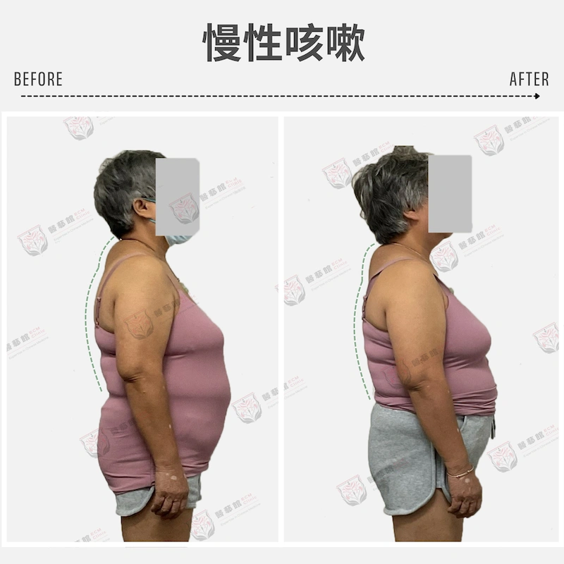 咳嗽未必是氣管問題,有時是結構被疤痕拉歪。