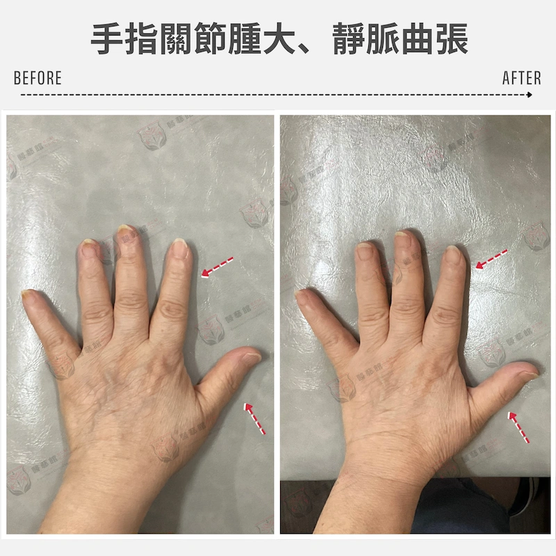手指關指腫大、靜脈曲張