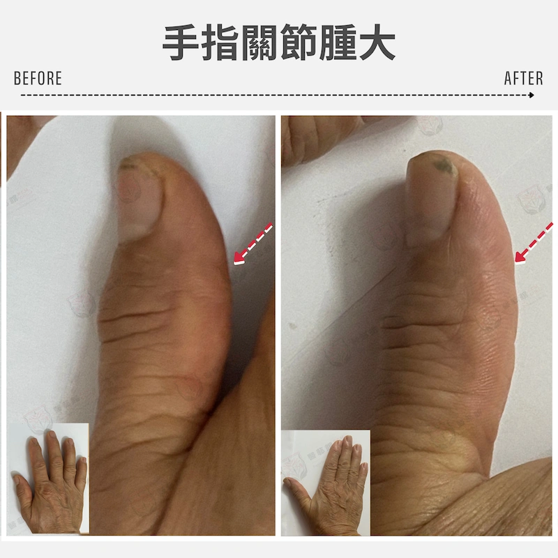手指關節腫大