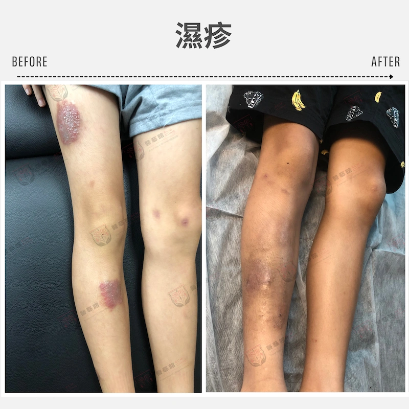 濕疹-1