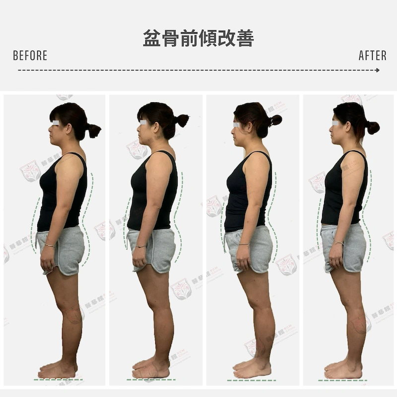 盆骨前傾 體態改善