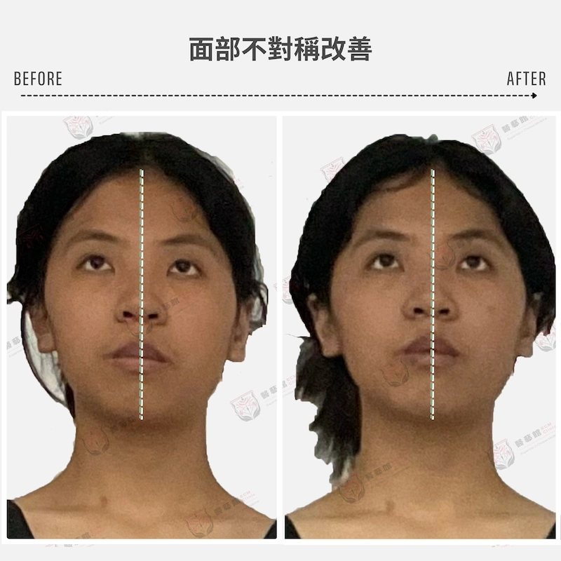 面部不對稱